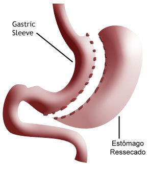gastroplastia_vertical_sleeve